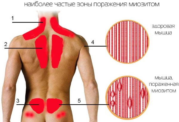 Онемение лица и головы признак какой болезни