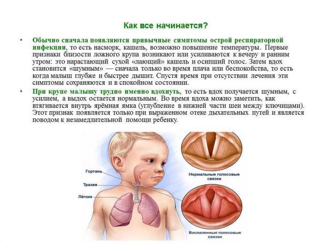 Ложный круп у детей (стенозирующий ларингит) – причины, симптомы, лечение