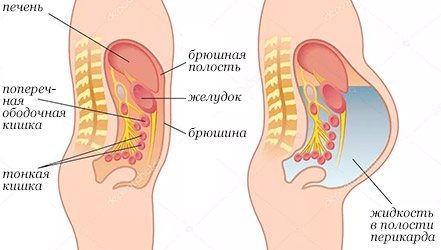 Асцит. причины, симптомы, признаки, диагностика и лечение патологии