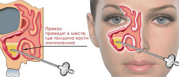 Последствия прокола гайморовых пазух - как избежать осложнений