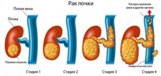 Особенности развития и лечения кисты почек