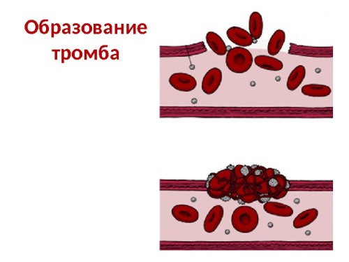 Тромбоэмболия: виды, причины, симптомы артериальной и венозной, лечение