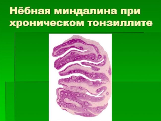 Хронический тонзиллит компенсированная форма что это