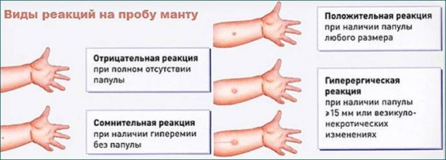 Большая манту в 6 лет: опасность или же норма?