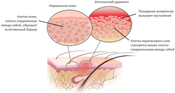 Диатез у грудничка: описание и тактика лечения