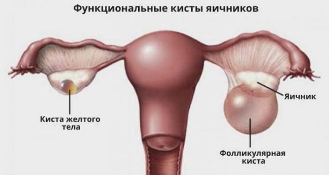 Жидкостное образование правого, левого яичника: что это такое