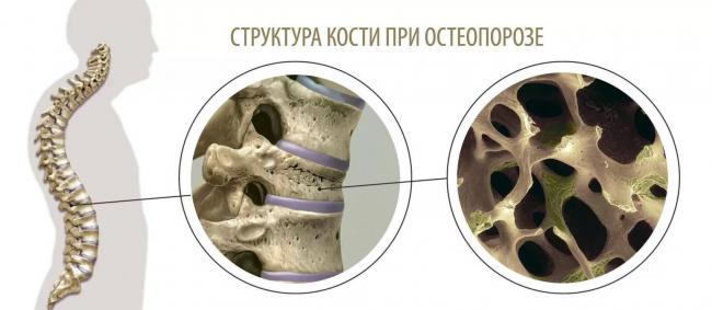Дексаметазон Dexamethasone инструкция по применению