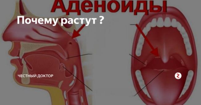 Аденоиды - причины, симптомы, диагностика и лечение