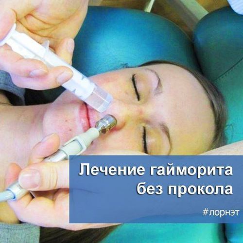 Как вылечить гайморит без прокола современными малоинвазивными методами
