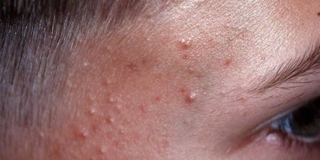 Ретиноевая мазь (retinoic ointment)