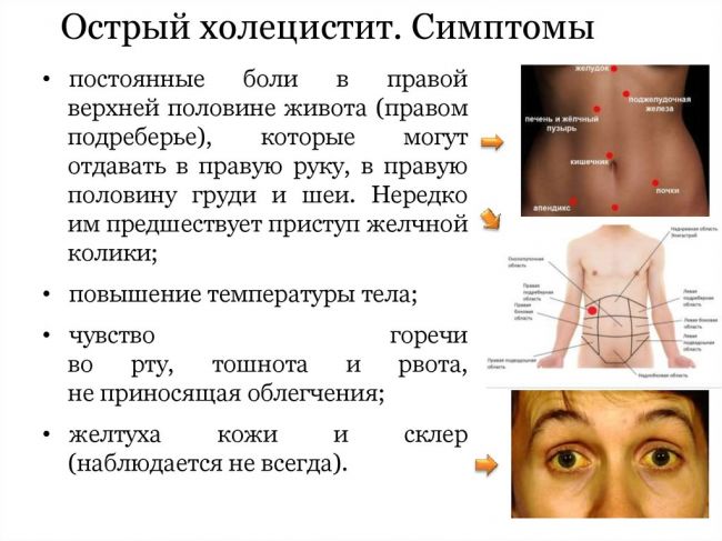 Что такое хронический холецистит и как его лечить