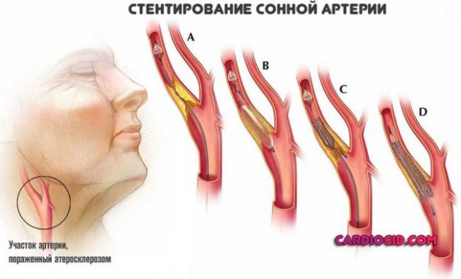 Церебральная ишемия у новорожденных: лечение, симптомы, последствия
