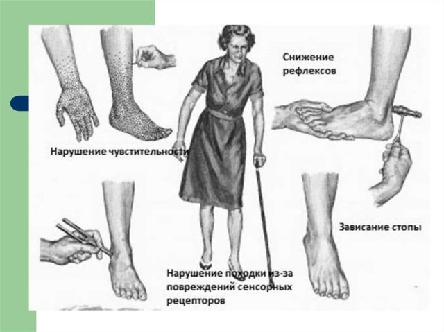 Симптомы и лечение диабетической полинейропатии