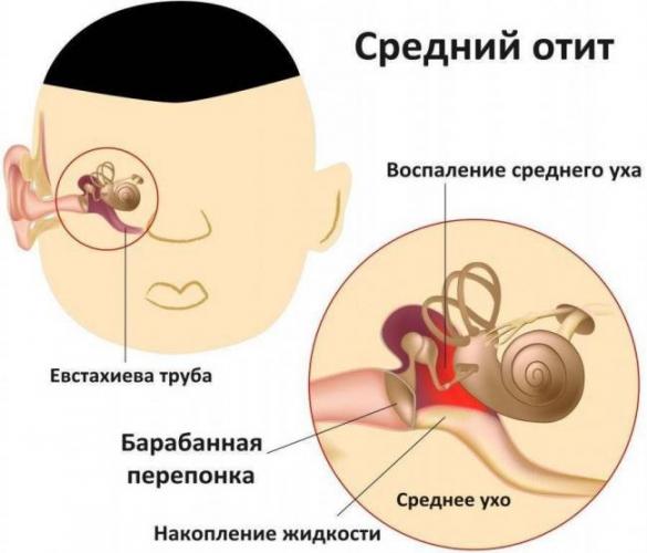 Боль в горле при глотании без температуры — острая, сильная, режущая, с одной стороны, если отдает в ухо. лечение в домашних условиях
