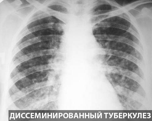 Рентгеновское исследование при пневмонии. симптомы, признаки, описание рентгена при пневмонии