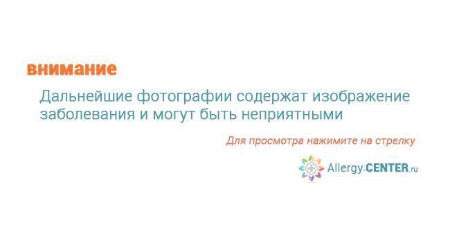 Что применять при укусе осы чем лечить укус осы при сильной аллергии