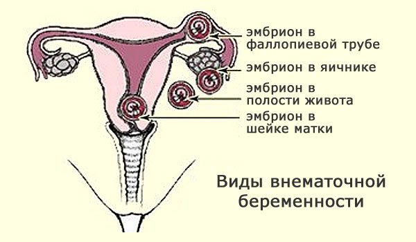 Внематочная беременность на ранних сроках
