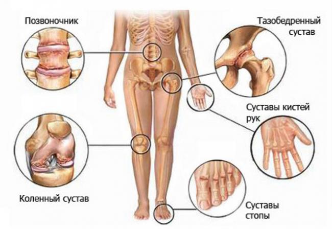 Диета при обострении артрита коленного сустава
