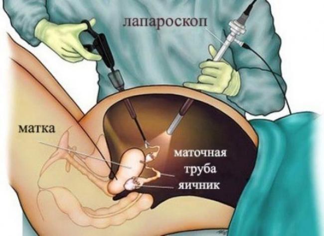 Виды кист на яичниках у женщин их особенности.