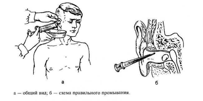 Что делать, если после отита заложено ухо?