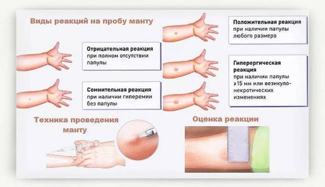 Можно ли делать манту при насморке: реакция на пробу манту у ребенка