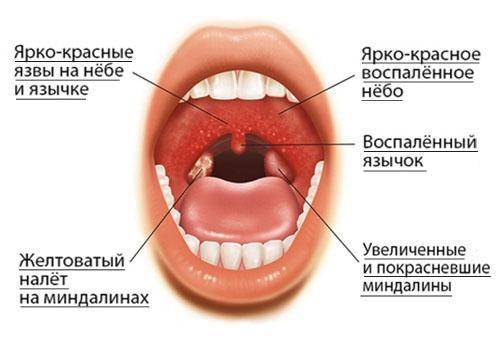 Боль в горле при глотании с одной стороны и отдает в ухо лечение