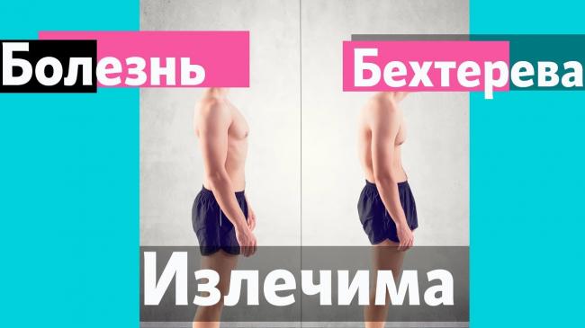 Анкилозирующий спондилит: симптомы и лечение