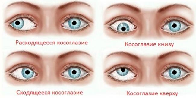 Расходящееся содружественное косоглазие у детей: классификация, причины развития, лечение