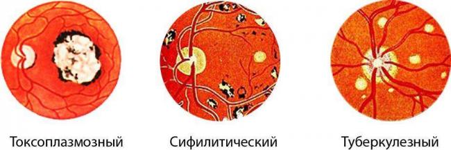 Хориоретинит глаза: что это такое, виды (центральный серозный, токсоплазмозный, туберкулезный, сифилитический, острый, очаговый), причины, симптомы, лечение, диагностика, осложнения, берут ли в армию