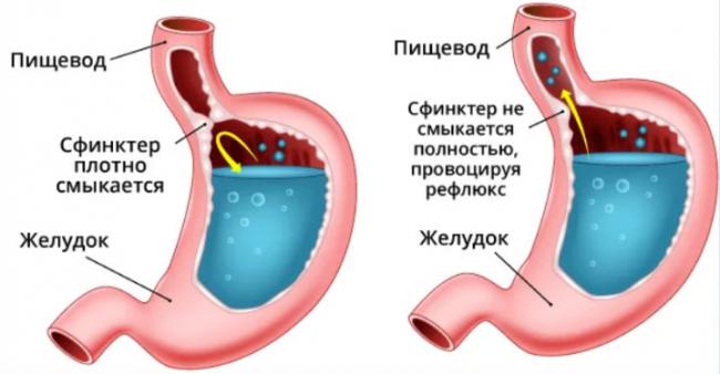Изжога после еды: причины и способы лечения (народные методы, препараты)