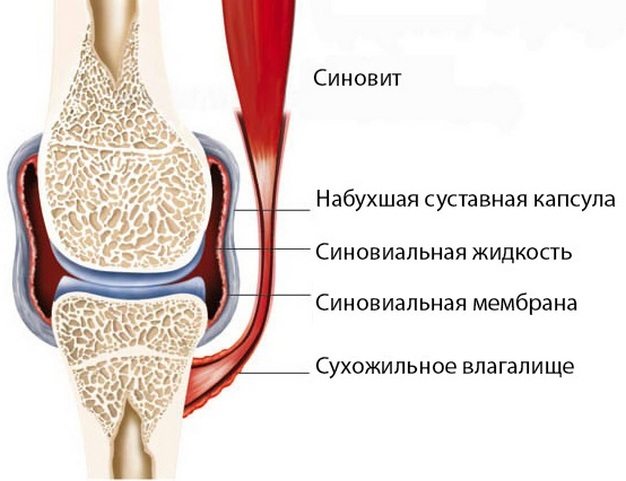 Синовит: симптомы и лечение синовита коленного сустава, тазобедренного сустава