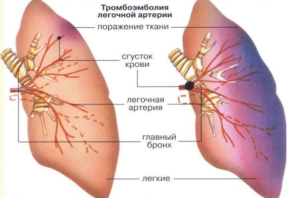 Венозный тромбоз - как его лечить? острая форма заболевания