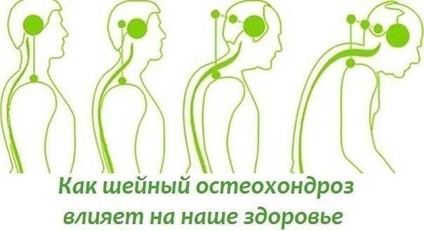 Остеохондроз