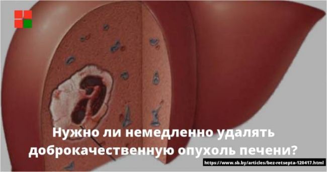 Множественные гемангиомы печени