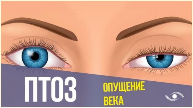 Птоз верхнего века: причины возникновения, оперативное лечение и безоперационная коррекция