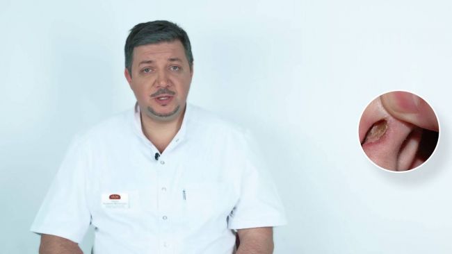 Лечение корок в носу