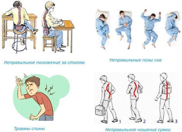 Левосторонний сколиоз