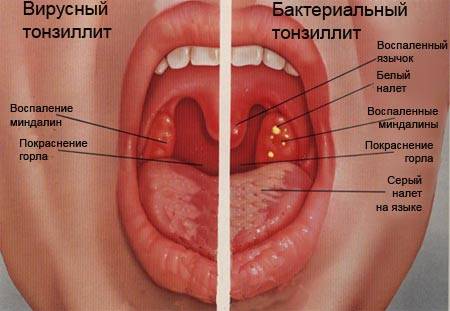 У ребенка болит горло без температуры чем лечить