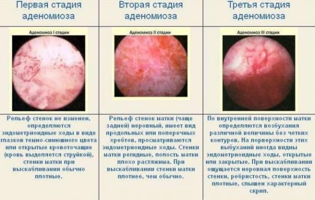 Аденомиоз