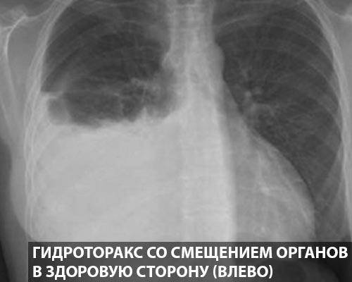 Рентгеновское исследование при пневмонии. симптомы, признаки, описание рентгена при пневмонии