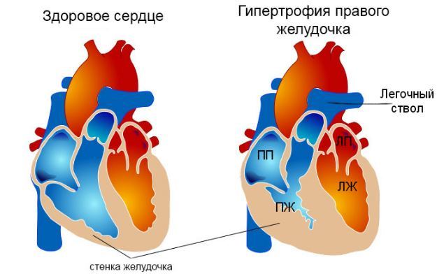 Гипертрофия левого желудочка сердца: экг, признаки, лечение | здрав-лаб