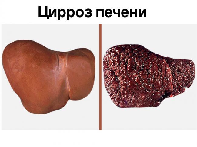 Что такоей фиброз печени и как лечить заболевание?