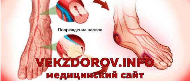 Диабетическая полинейропатия нижних конечностей: как распознать и вылечить?