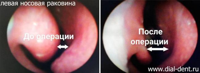 Вазомоторный ринит: формы, симптомы и лечение у взрослых