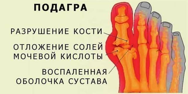 Диета при повышенном уровне мочевой кислоты