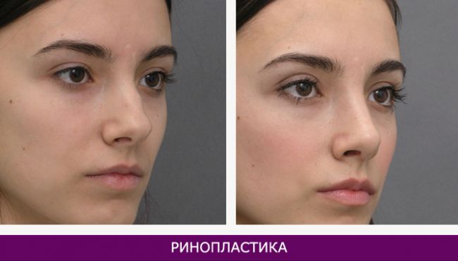 Безоперационная ринопластика: обзор методов и их эффективность