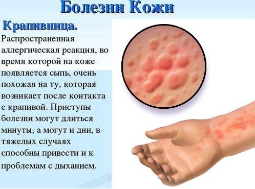 Что такое токсикодермия, причины и лечение токсико-аллергического дерматита