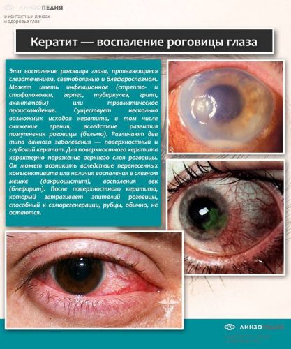 Лопнул капилляр в глазу: причины, симптомы, лечение