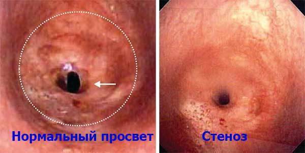Круп у детей – симптомы и лечение, первая помощь