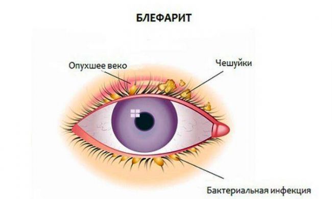 Отек верхнего века у переносицы